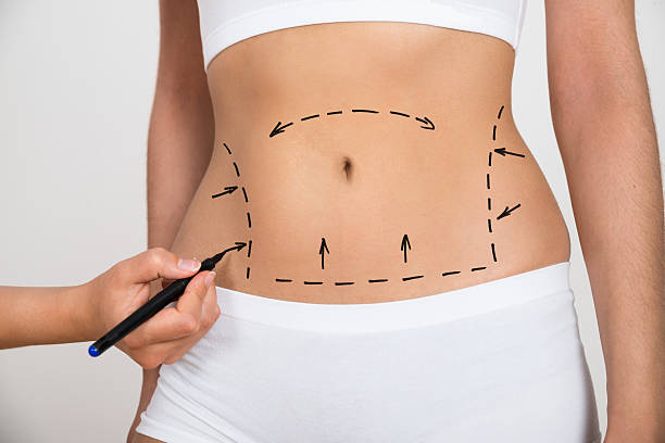 Liposukcja i co dalej ? Therapy Zone - Katarzyna jarych - Liposukcja i co dalej ?