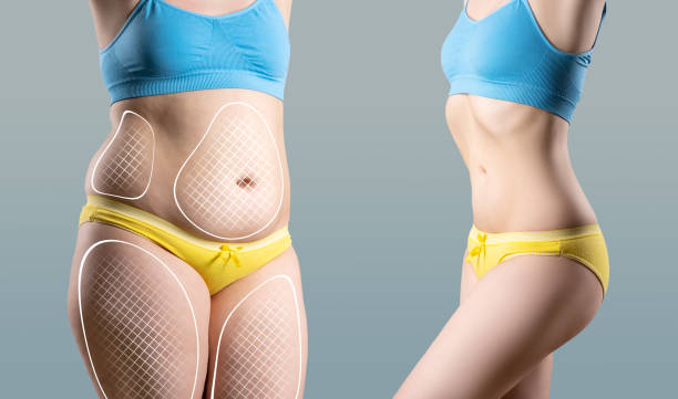 Liposukcja i co dalej ? Therapy Zone - Katarzyna jarych - Liposukcja i co dalej ?